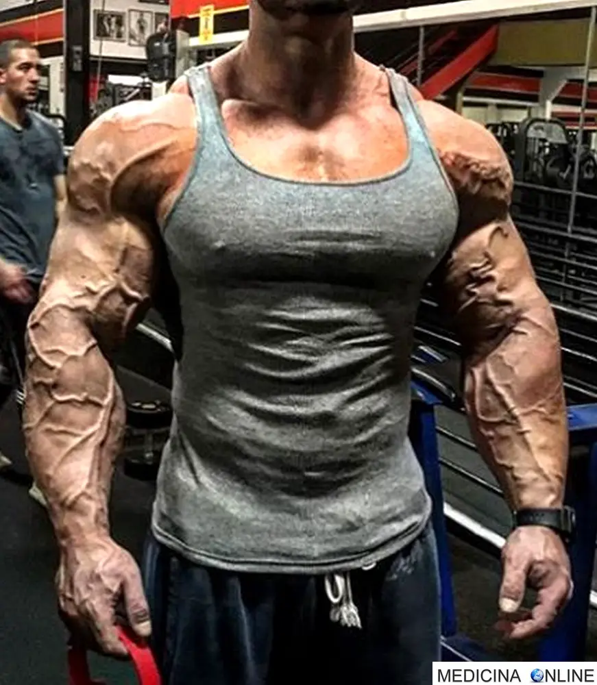 Aumento innaturale della vascolarizzazione nel bodybuilder MEDICINA ONLINE