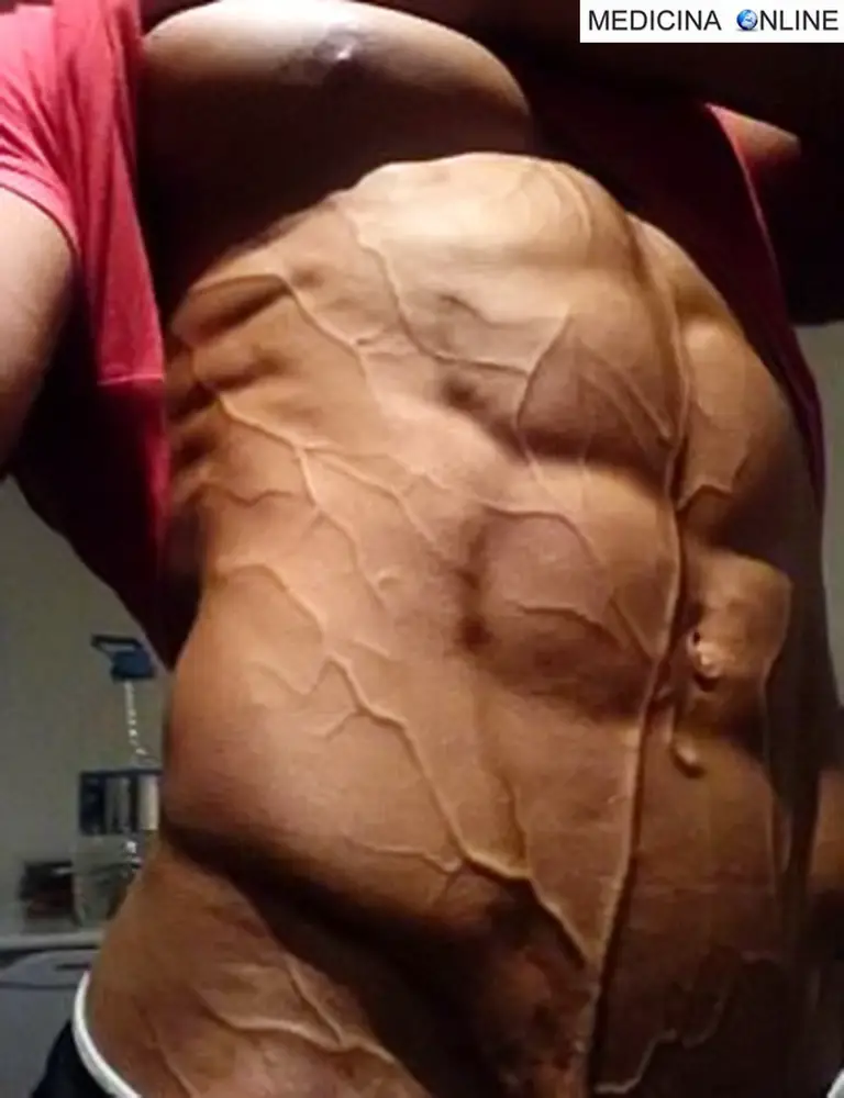 MEDICINA ONLINE DOPING BODYDUILDING VASCOLARIZZAZIONE IMMAGINE.