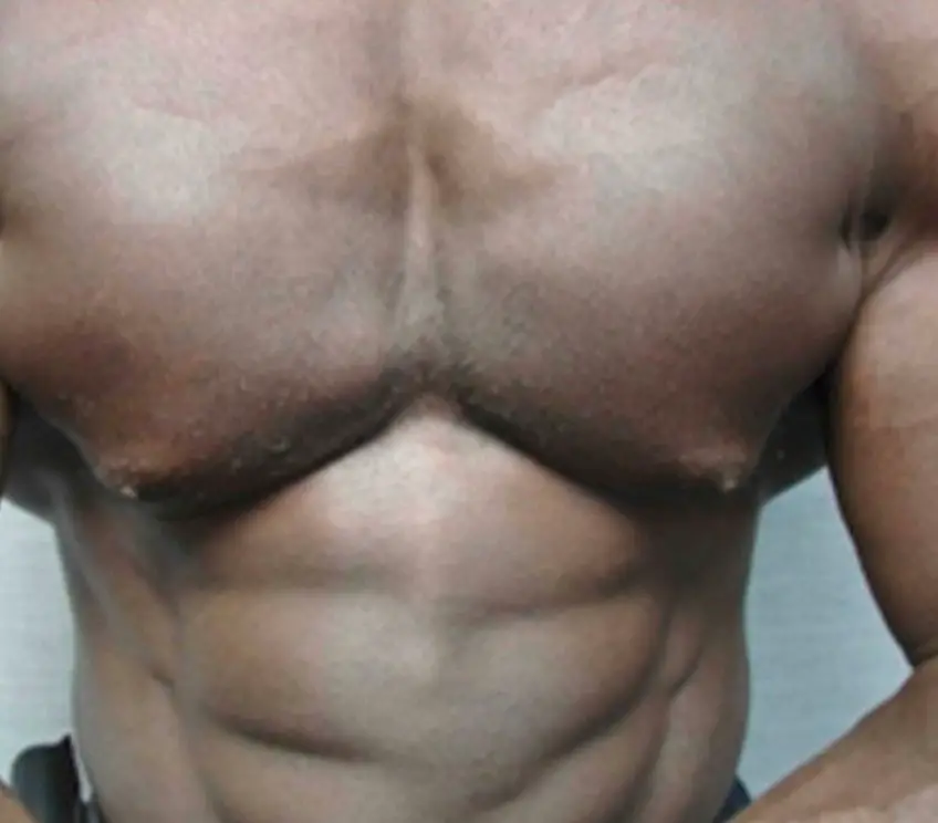 MEDICINA ONLINE GINECOMASTIA DOPING BODY BUILDING IMMAGINE.