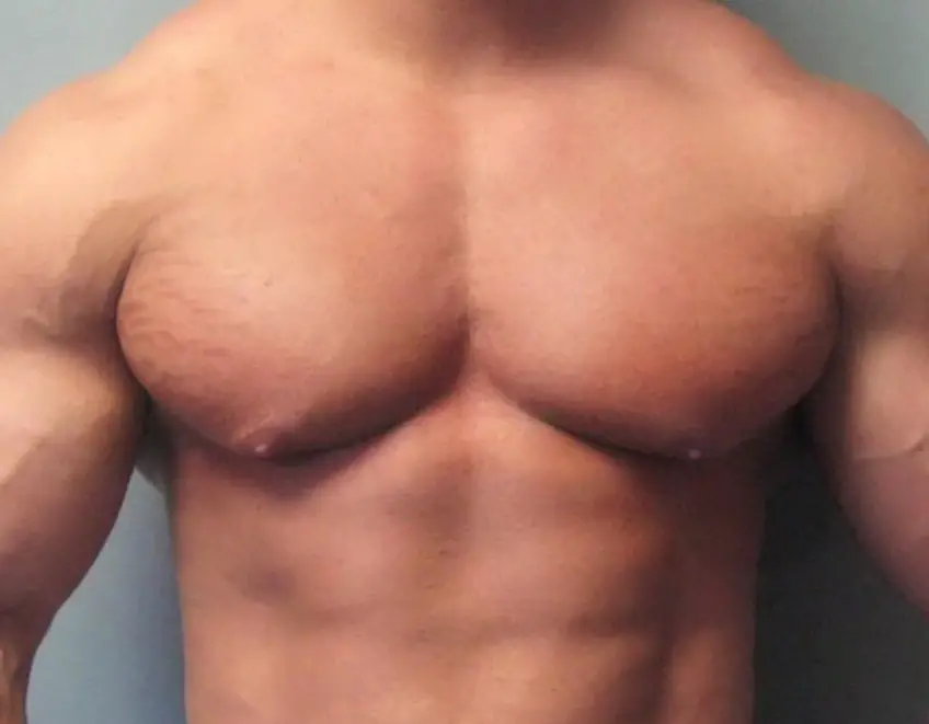 MEDICINA ONLINE GINECOMASTIA DOPING BODY BUILDING IMMAGINE.