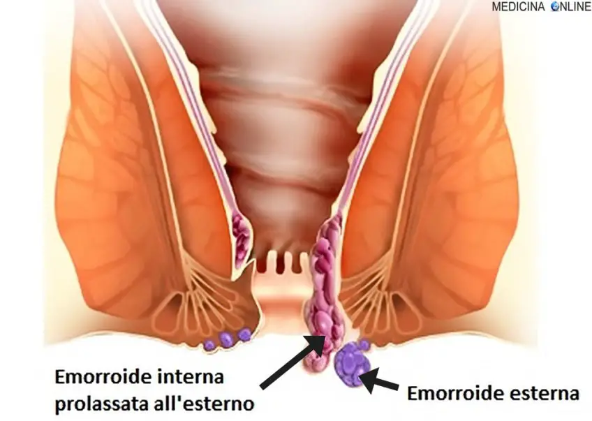 MEDICINA ONLINE EMORROIDI INTERNE ESTERNE PROLASSO ANO RETTO FECI CILINDRO FECALE SANGUE ANALE COLON PROCTOLOGO DEFECARE EVACUARE PONZAMENTO DOLORE BRUCIORE CACCA MELENA.