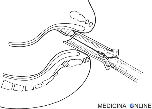 MEDICINA TERAPIA SCLEROSANTE EMORROIDI INFISSIONE AGO ANO AL DI SOPRA DELLA LINEA PETTINEA