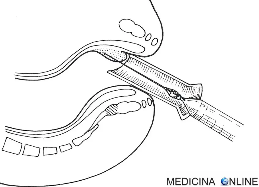 MEDICINA TERAPIA SCLEROSANTE EMORROIDI INFISSIONE AGO ANO AL DI SOPRA DELLA LINEA PETTINEA.