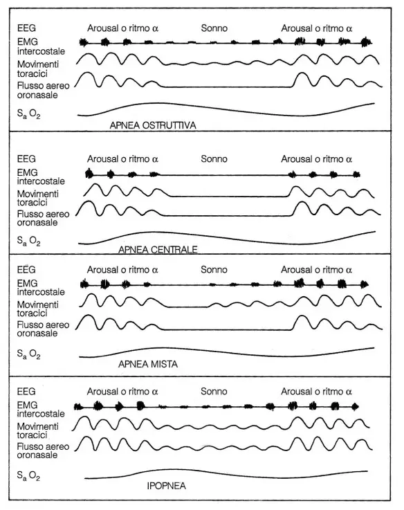 MEDICINA ONLINE Rappresentazione schematica dei vari tipi di apnea e di un'ipopnea. Dall'alto verso il basso apnea ostruttiva, apnea centrae, apnea mista, ipopnea.jpg