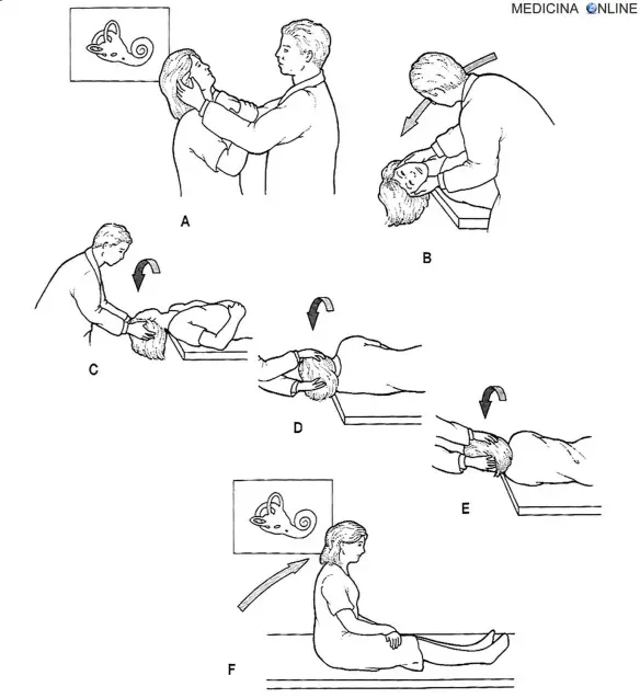 MEDICINA ONLINE VERTIGINE POSIZIONALE BENIGNA SEMEIOTICA Manovra di Dix-Hallpike per l'induzione della vertigine posizionale benigna (A e B) e trattamento con la manovra di riposizionamento canalicolare (C-F).