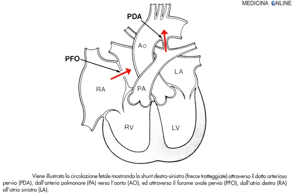 MEDICINA ONLINE Shunt destro-sinistro attraverso il dotto arterioso pervio (PDA), dall'arteria polmonare (PA) verso l'aorta (AO) e attraverso il forame ovale pervio (PFO) dall'atrio destro (RA) all'atrio sinistro