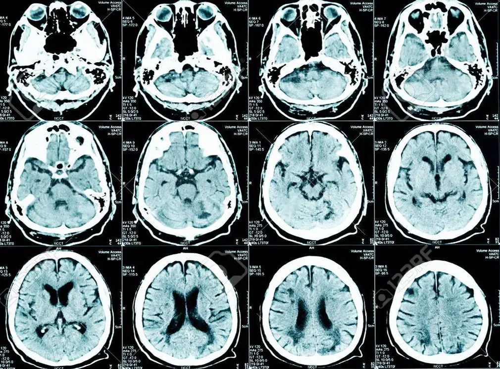 MEDICINA ONLINE NEUROLOGIA NEUROLOGO CERVELLO ENCEFALO SISTEMA NERVOSO RISONANZA MAGNETICA RM TAC TC TOMOGRAFIA COMPUTERIZZATA DIAGNOSTICA PER IMMAGINI RADIOGRAFIA RX