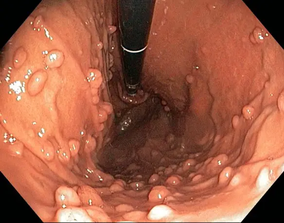 MEDICINA ONLINE POLIPI INTESTINALI GASTROSCOPIA COLONSCOPIA INTESTINO COLON ENDOSCOPIA POLIPOSI ADENOMATOSA FAMILIARE GASTROENTEROLOGIA POLIPECTOMIA.jpg