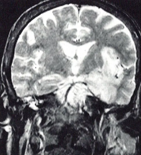 MEDICINA ONLINE Encefalite da herpes simplex Immagine risonanza magnetica coronale pesata in T2 su un piano assiale segnale iperintenso lobo temporale corteccia insulare.jpg