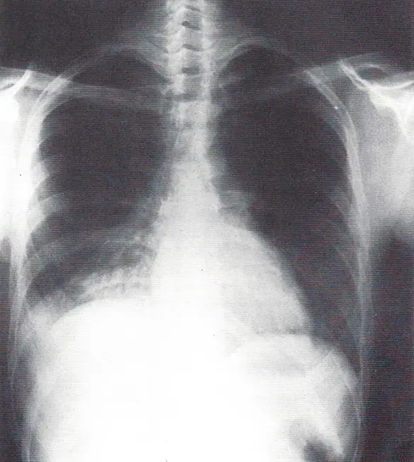 MEDICINA ONLINE TROMBO EMBOLIA POLMONARE POLMONI RADIOGRAFIA TORACE RX ELEVAZIONE EMIDIAFRAMMA DESTRA RADIOPACITA DEL LOBO POLMONARTE INFERIORE DESTRO ATELETTASIA