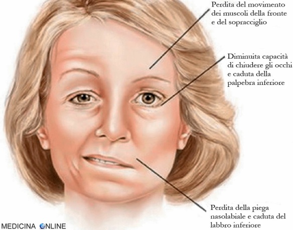 DOTT. EMILIO ALESSIO LOIACONO MEDICO CHIRURGO DIRETTORE MEDICINA ONLINE PARALISI DI BELL EMIPARESI FACCIALE FACCIA VISO NERVO FACCIALE LESIONE RIABILITAZIONE LABBRA CASCANTI OCCHIO APERTO SI PUO CURARE TERAPIA DONNA