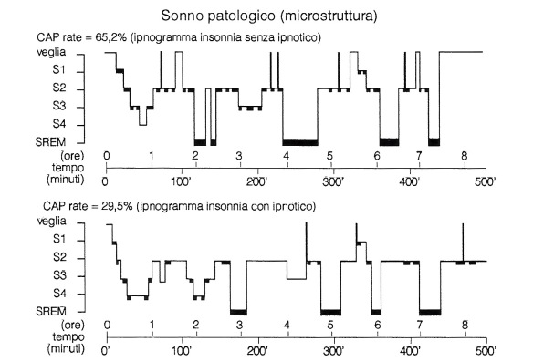 MEDICINA ONLINE SONNO Nella maggior parte delle insonnie, l'indice CAP (CAP rate) aumenta in misura significativa, anche nei casi in cui la macrostruttura è conservata.jpg