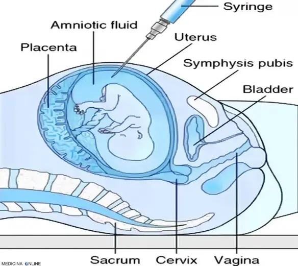 MEDICINA ONLINE AMNIOCENTESI ANALISI LIQUIDO AMNIOTICO FETO NEONATO GRAVIDANZA MATERNITA INCINTA DIAGNOSI PRENATALE MALATTIE GENETICHE VILLI CORIALI UTERO.jpg