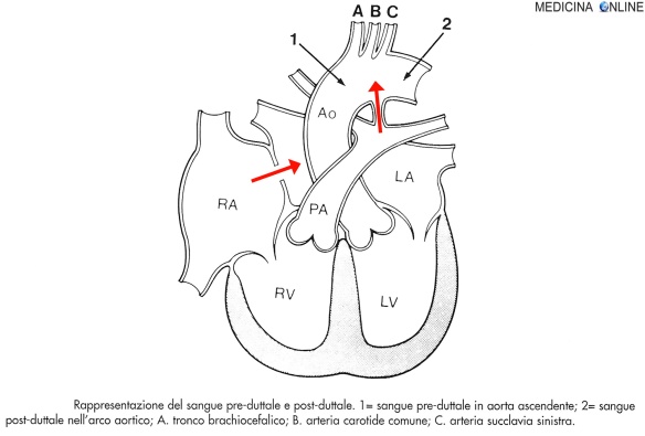 MEDICINA ONLINE Shunt destro-sinistro attraverso il dotto arterioso pervio (PDA), dall'arteria polmonare (PA) verso l'aorta (AO) e attraverso il forame ovale pervio (PFO) dall'atrio destro (RA) all'atrio sinistro