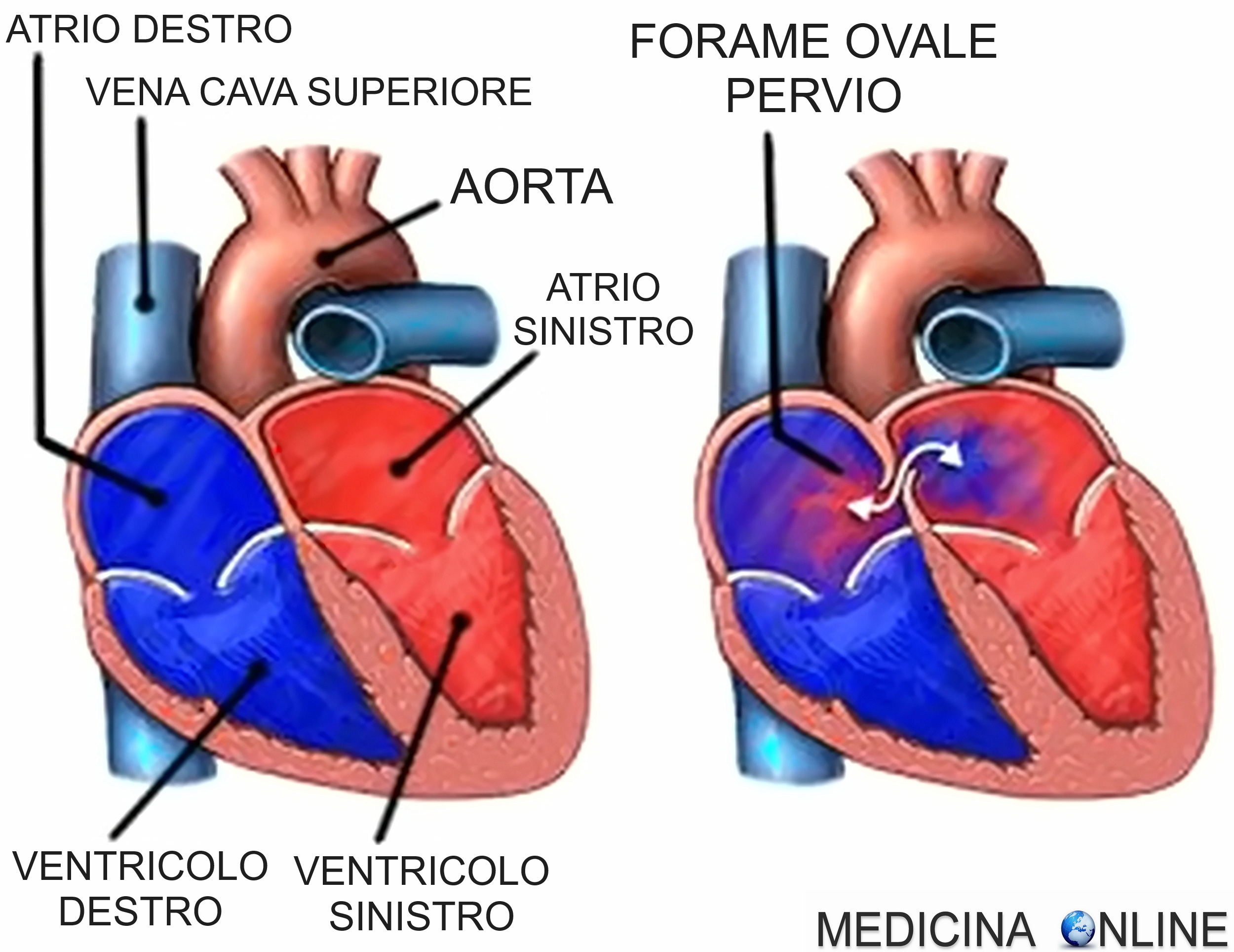 Setto Difetti del setto interatriale: cause, sintomi, diagnosi, terapia ...