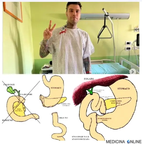 Fedez ha subito un complicato intervento al pancreas per rimuovere un tyumore