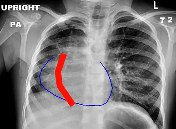 Posizione della vena scimitarra