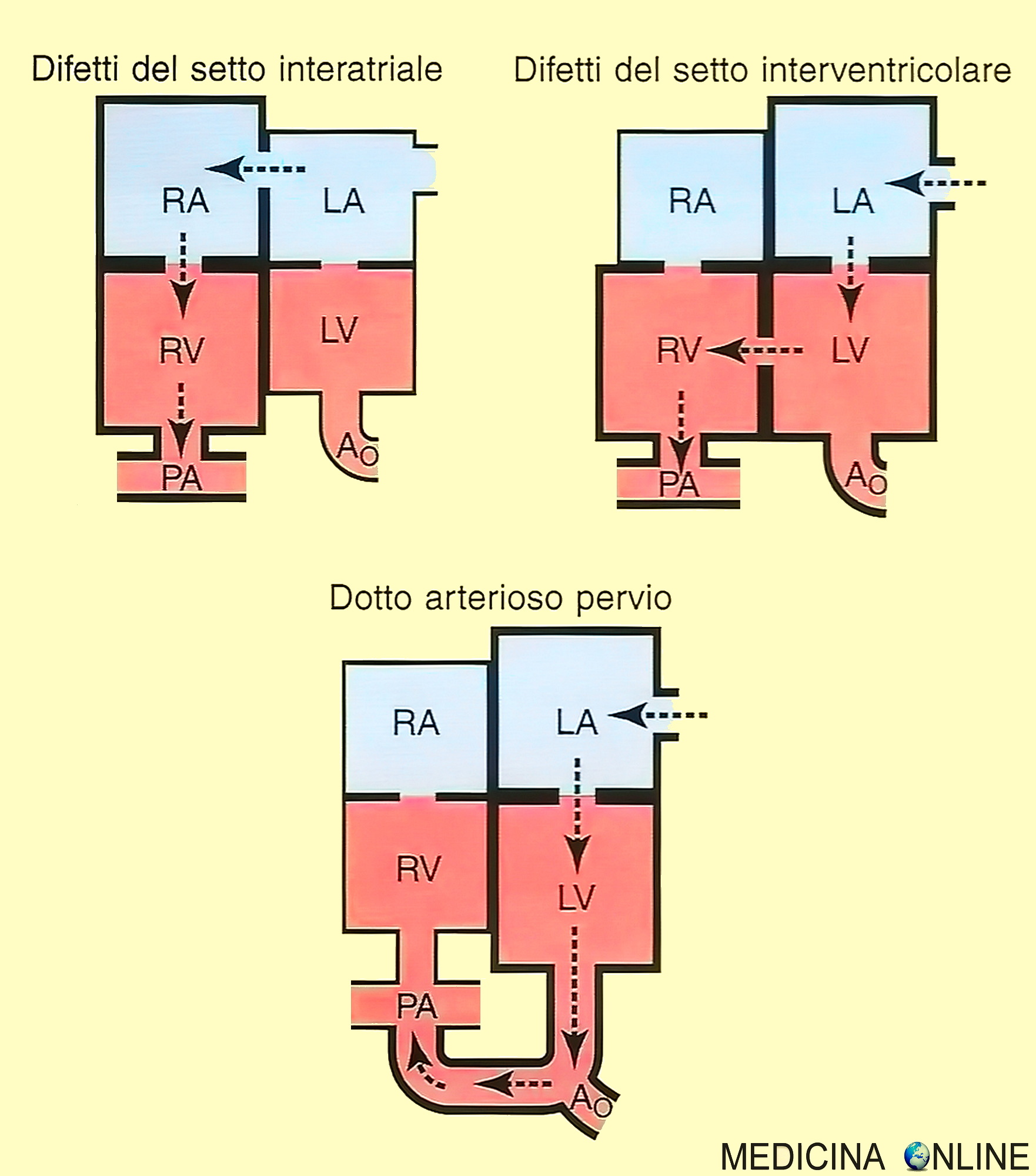 SCHEMA CHE MOSTRA LE MALFORMAZIONI CONGENITE CARDIACHE - DIFETTO DEL SETTO INTERATRIALE INTERVENTRICOLARE DOTTO ARTERIOSO PERVIO