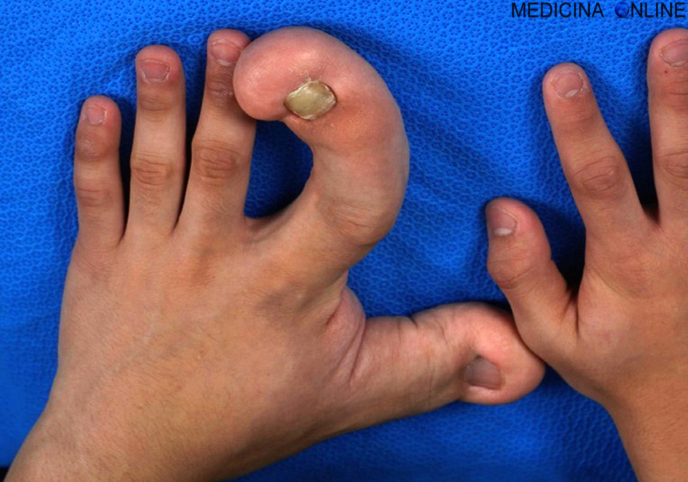 DOTT. EMILIO ALESSIO LOIACONO MEDICO CHIRURGO DIRETTORE MEDICINA ONLINE MACRODISTROFIA LIPOMATOSA GIGANTISMO PARZIALE LOCALIZZATO MANO PIEDE DITA MACRODYSTROPHIA LIPOMATOSA 1