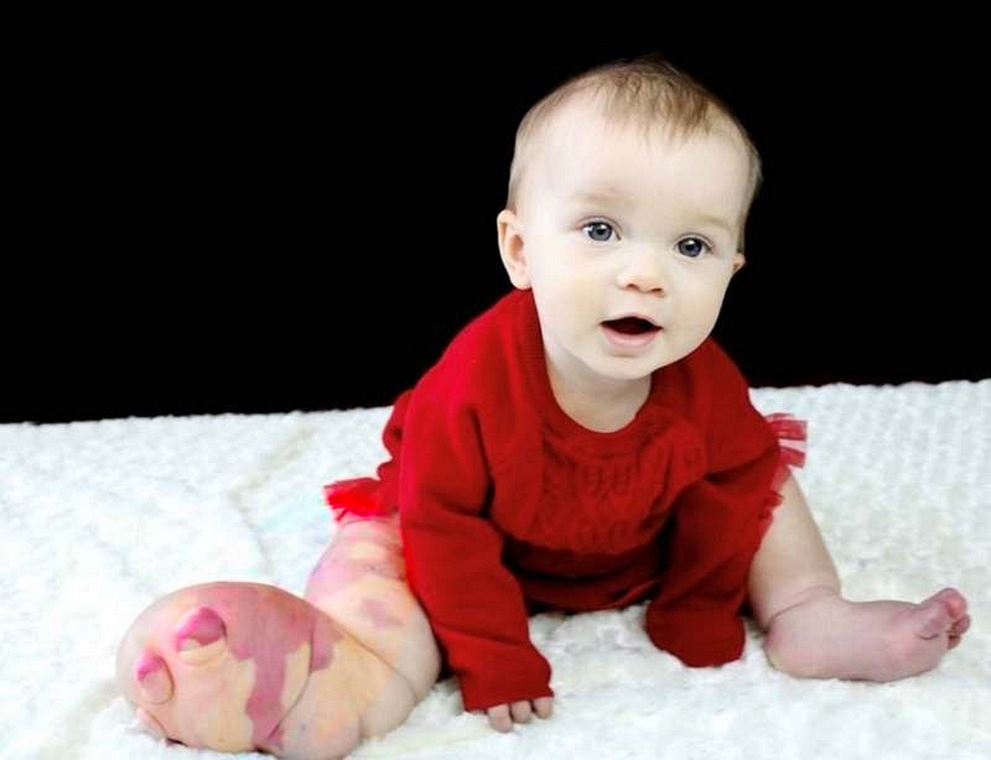 DOTT. EMILIO ALESSIO LOIACONO MEDICO CHIRURGO DIRETTORE MEDICINA ONLINE SINDROME CLOVE CLOVES SYNDROME BAMBINO GENETICA CONGENITA MALFORMAZIONE GAMBA GIGANTISMO PROTEO PROTEUS