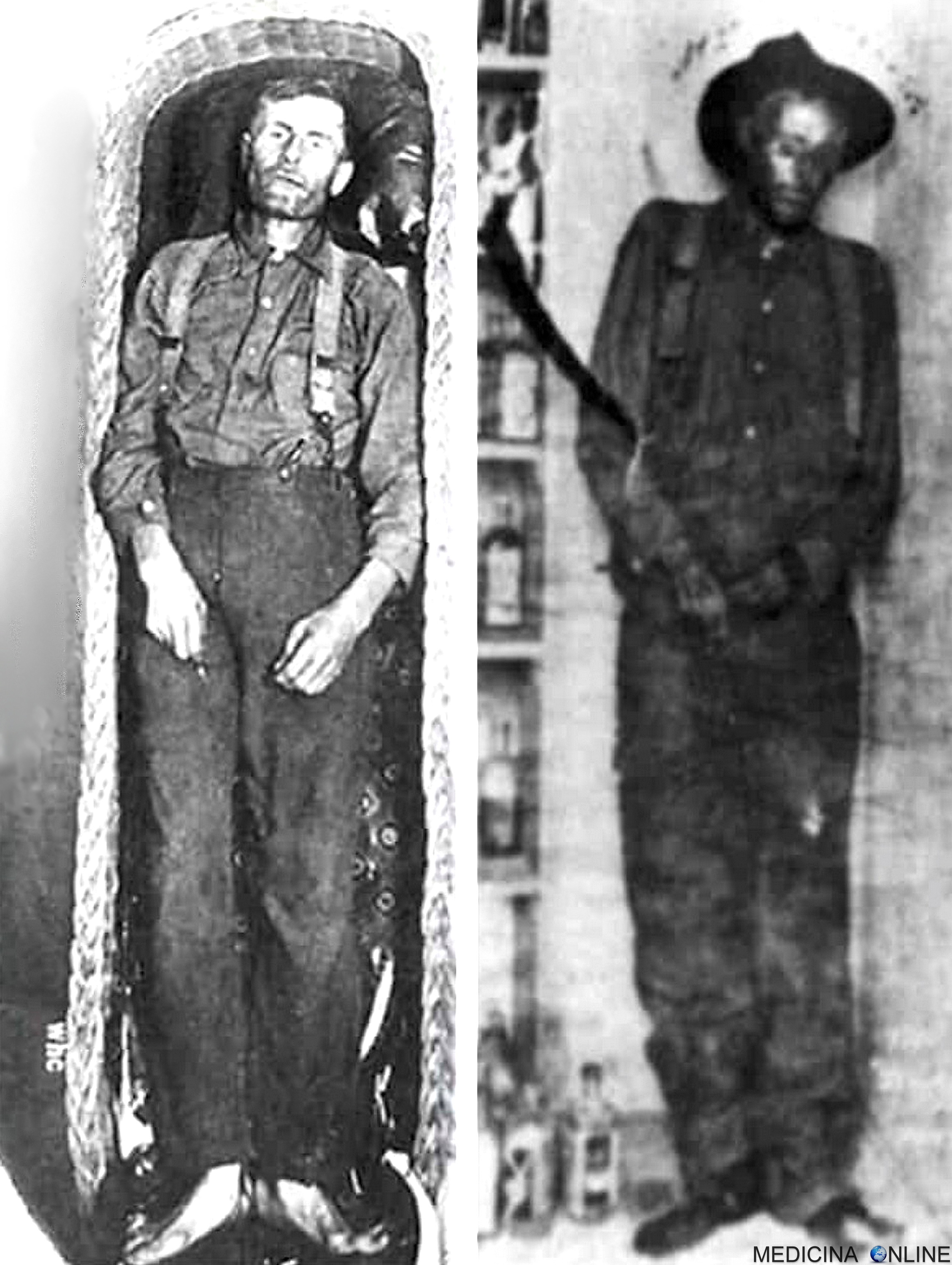 DOTT. EMILIO ALESSIO LOIACONO MEDICO CHIRURGO DIRETTORE MEDICINA ONLINE ELMER MCCURDY MANICHINO CADAVERE STATUA DI CERA ATTORE MORTO SEPOLTO CORPO DEFUNTO STORIA RACCAPRICCIANTE TOMBA FUNERALE MUMMIFICATO IMBALSAMATO 1