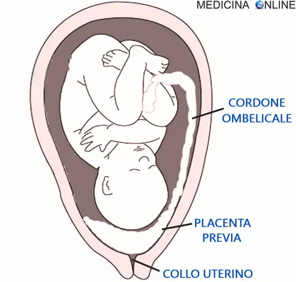 MEDICINA ONLINE EMILIO ALESSIO LOIACONO MEDICO CHIRURGO PLACENTA PREVIA GRAVIDANZA MAMMA FETO FIGLIO FUNICOLO CORDONE OMBELICALE