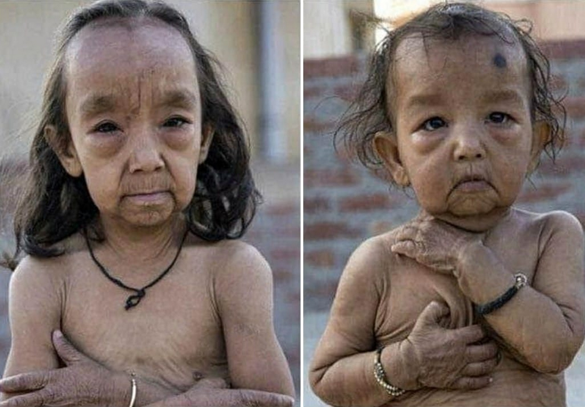 Progeria (sindrome di Benjamin Button): cause, trasmissione, età di ...