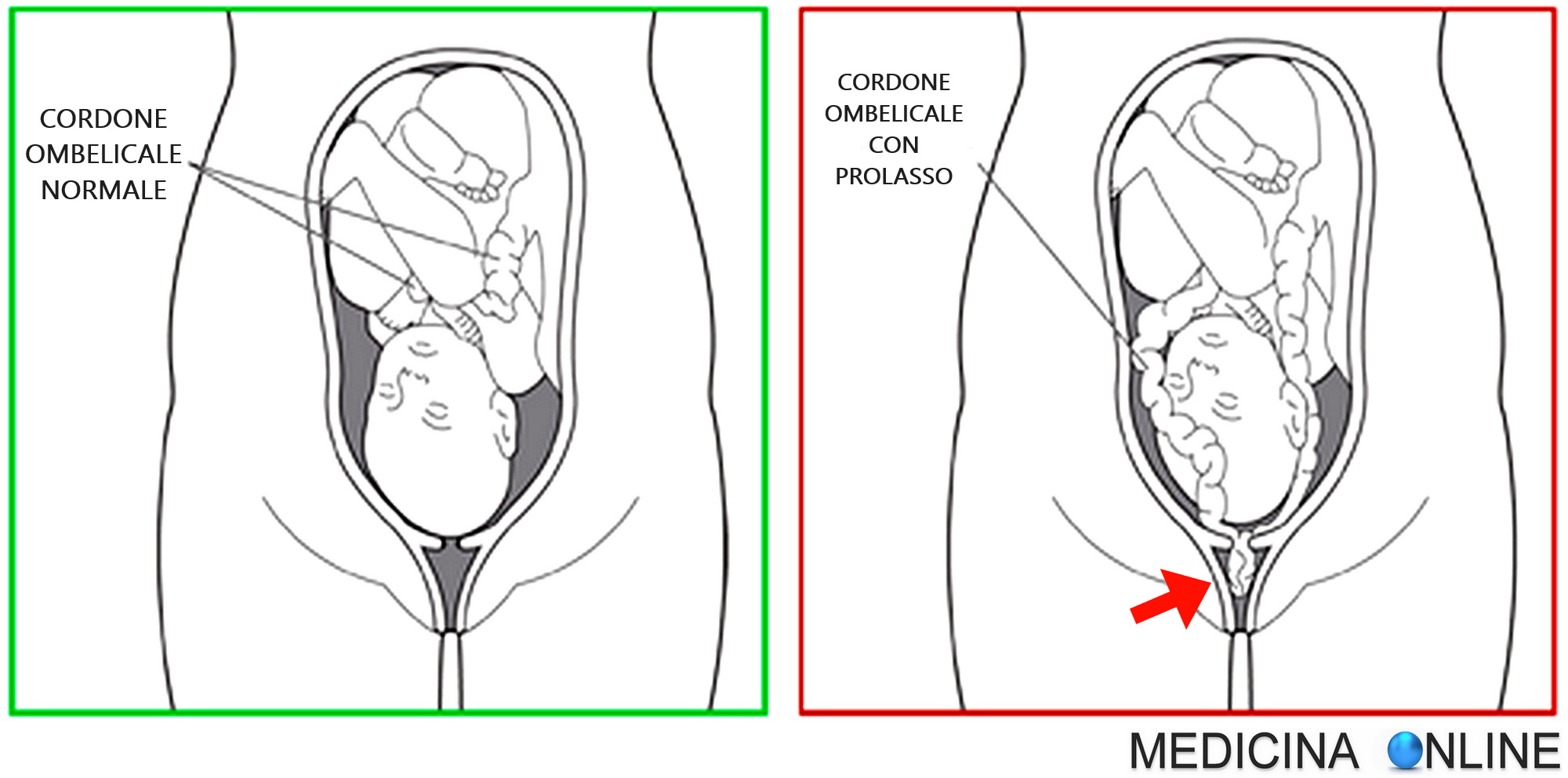 Prolasso del cordone ombelicale: cause, sintomi, diagnosi, terapie,  conseguenze sul feto, mortalità | MEDICINA ONLINE, image size:2000x992