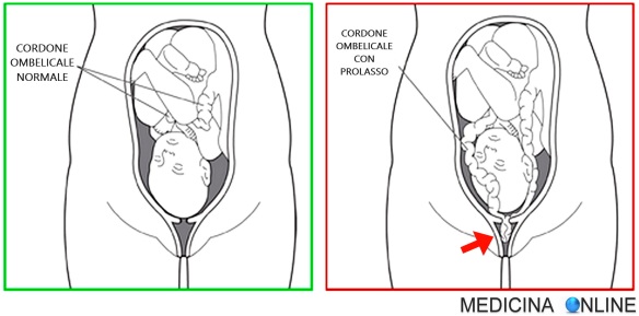 MEDICINA ONLINE EMILIO ALESSIO LOIACONO MEDICO CHIRURGO PROLASSO DEL CORDONE OMBELICALE FUNICOLO FETO COMPRESSIONE ASFISSIA ENCEFALOPATIA IPOSSICO ISCHEMICA NEONATO NEONATALE PARTO EMERGENZA OSTETRICA VAGINA UTERO