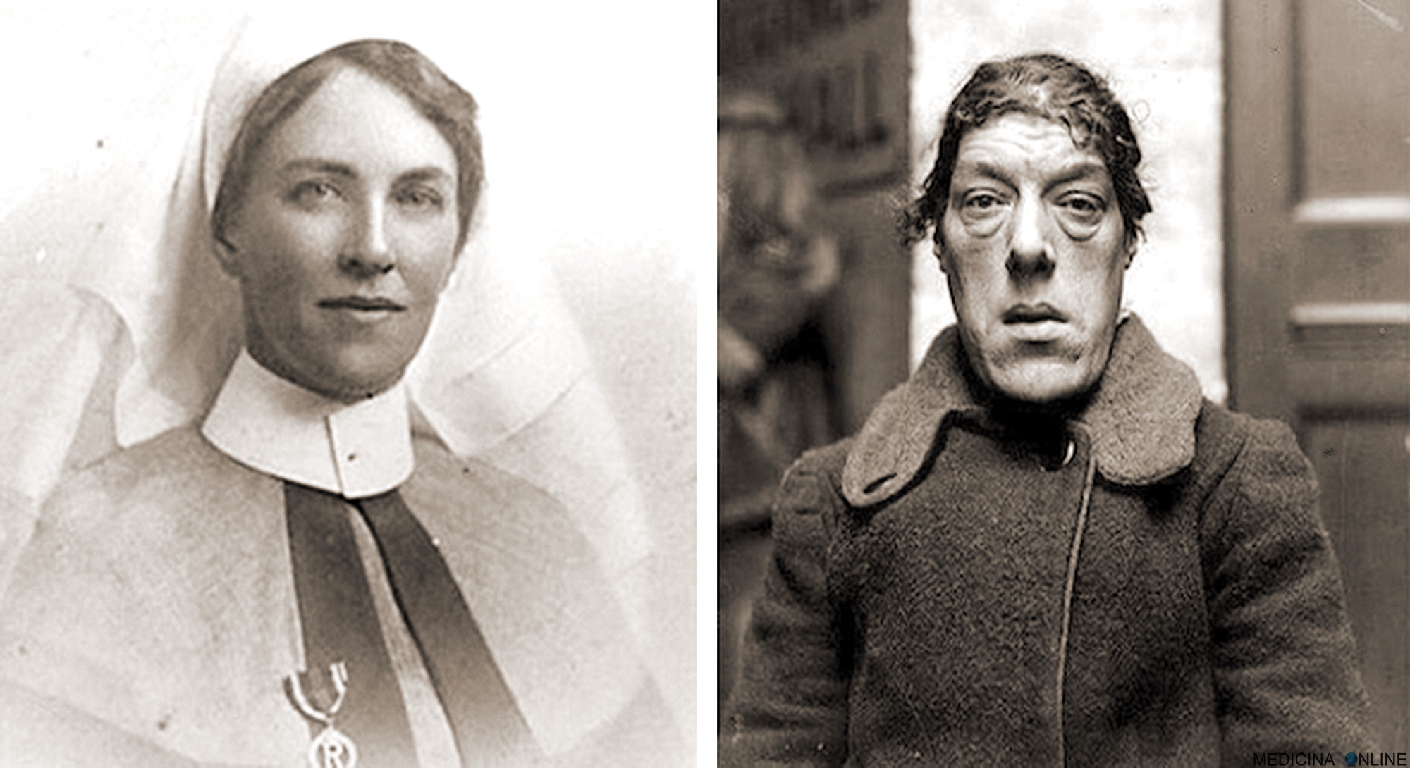 MEDICINA ONLINE EMILIO ALESSIO LOIACONO MEDICO CHIRURGO MARY ANN BEVAN TRISTE STORIA INFERMIERA DONNA PIU BRUTTA DEL MONDO A CAUSA ACROMEGALIA ORMONE DELLA CRESCITA GH