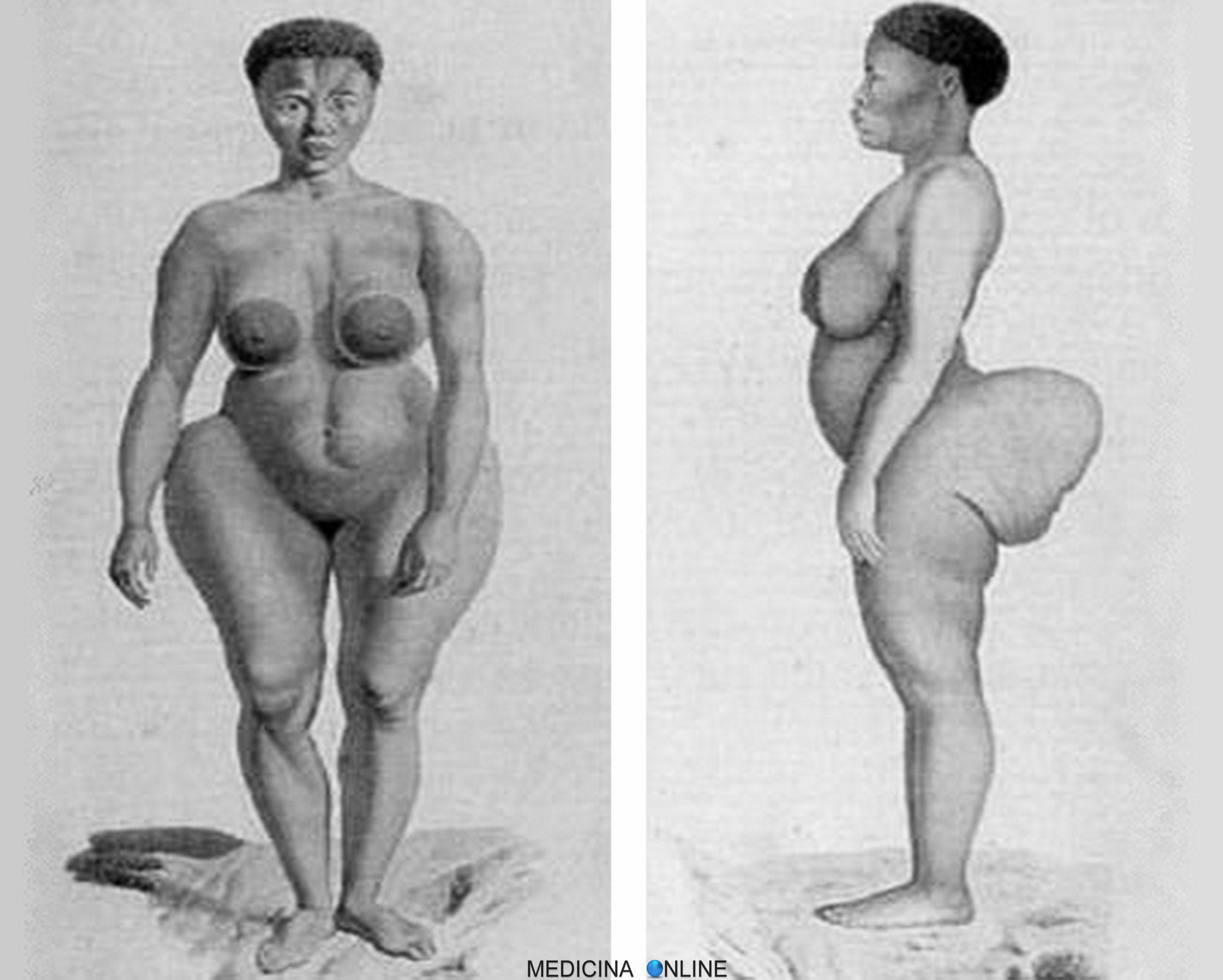 Saartjie Baartman, la Venere ottentotta considerata fenomeno da baraccone  per la forma dei glutei | MEDICINA ONLINE