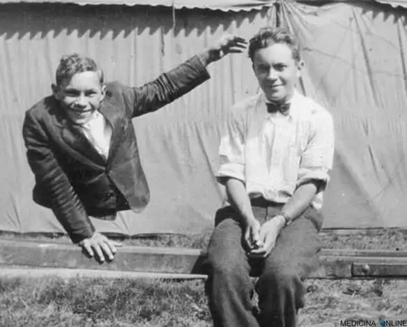 MEDICINA ONLINE EMILIO ALESSIO LOIACONO MEDICO CHIRURGO JOHNNY ECK ECKHARDT ROBERT BROS FRATELLI TWIN GEMELLI ETEROZIGOTI FREAK SHOW FENOMENI DA BARACCONE