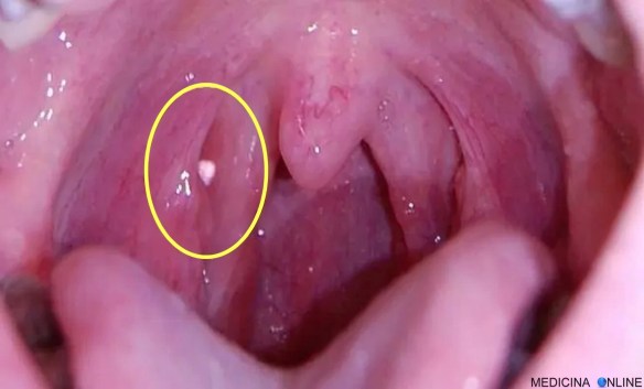 MEDICINA ONLINE EMILIO ALESSIO LOIACONO MEDICO CHIRURGO TONSILLOLITO TONSILLE BOCCA FOTO