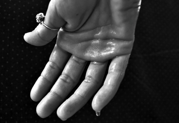 MEDICINA ONLINE EMILIO ALESSIO LOIACONO MEDICO CHIRURGO MANO SUDORE IPERIDROSI SUDORAZIONE ECCESSIVA CATTIVO ODORE