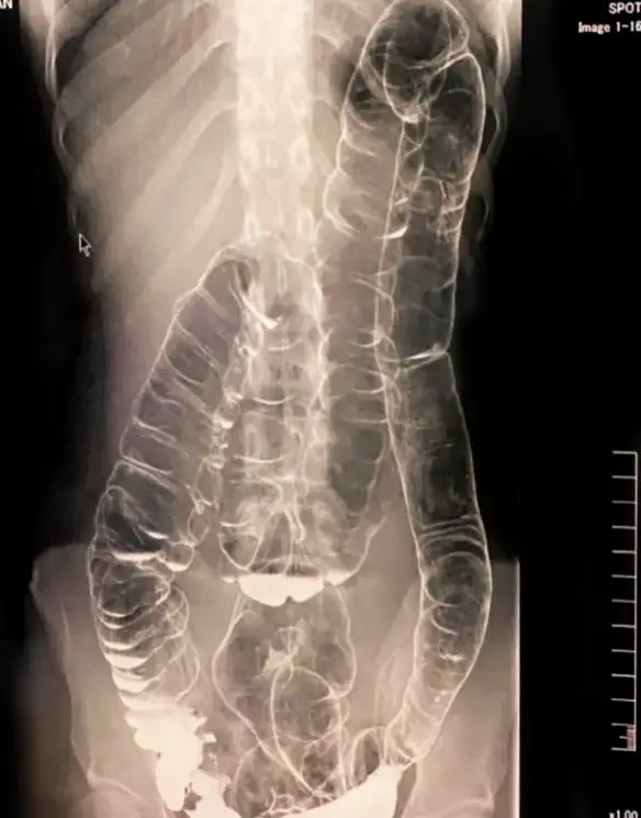 MEDICINA ONLINE Colon di paziente donna dopo 19 giorni di costipazione. Ben visibile la severa distorsione del profilo intestinale, a causa dell'eccessiva quantità di feci nel lume