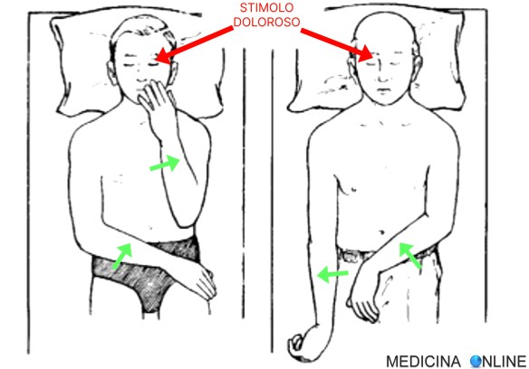 MEDICINA ONLINE EMILIO ALESSIO LOIACONO STIMOLO DOLOROSO OCCHIO PAZIENTE IN COMA REAZIONI RISPOSTE