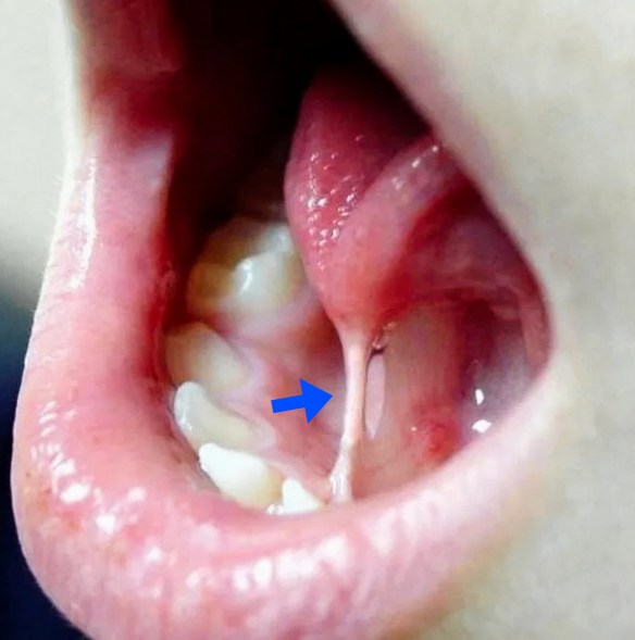 MEDICINA ONLINE EMILIO ALESSIO LOIACONO Anchiloglossia Filetto sotto la lingua Tongue tie Lingua dalla mobilità ridotta Vocca Labbra